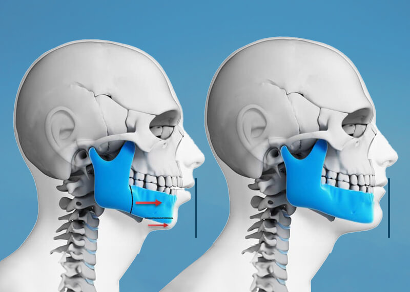 jawbone before and after corrective jaw surgery