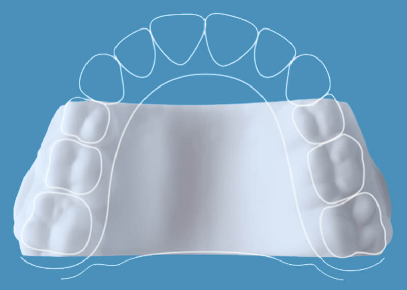 a diagram of where the Invisalign Palatal Expander sits in your mouth